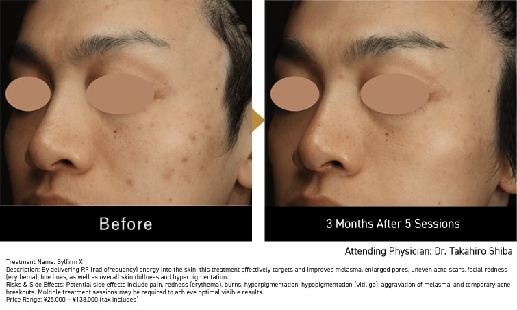 Improvement of Uneven Skin Tone and Acne Scars