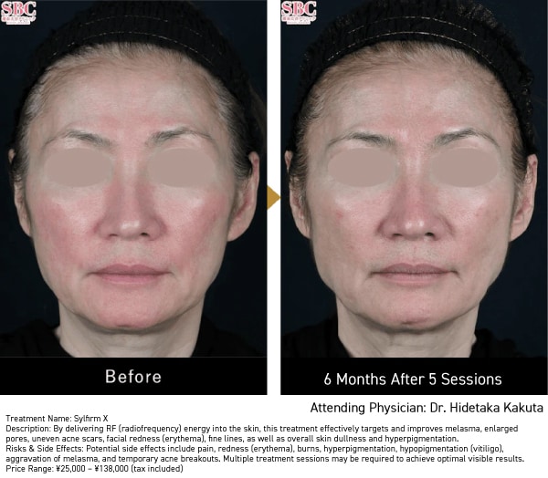 Improvement of Facial Redness (Rosacea / Flush Skin)