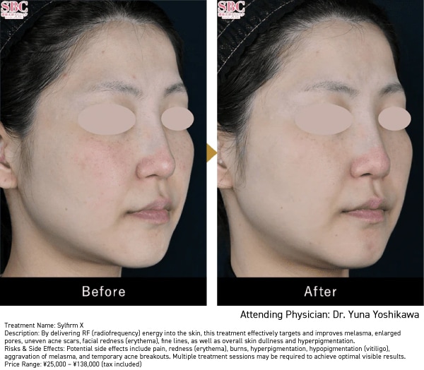 Improvement of Melasma and Facial Redness
