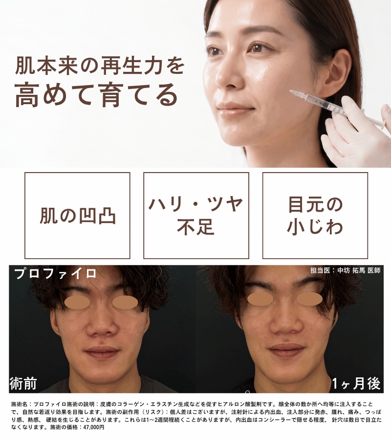 肌育注射