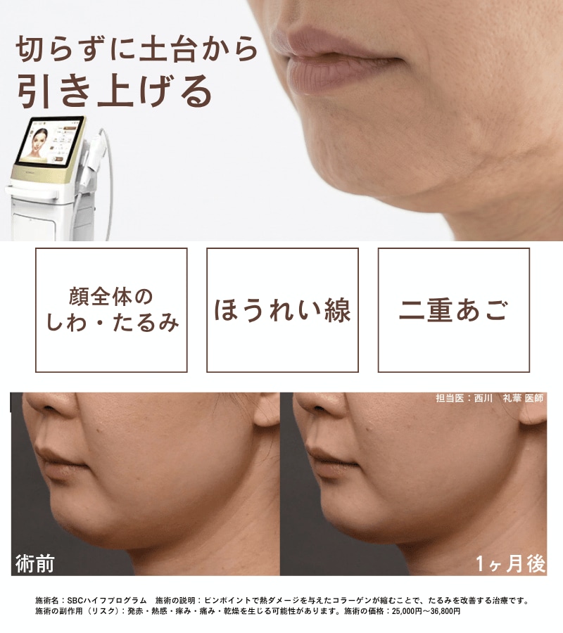 SBCハイフプログラム