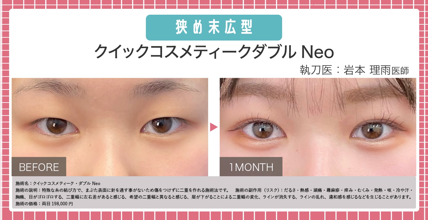 狭め末広型