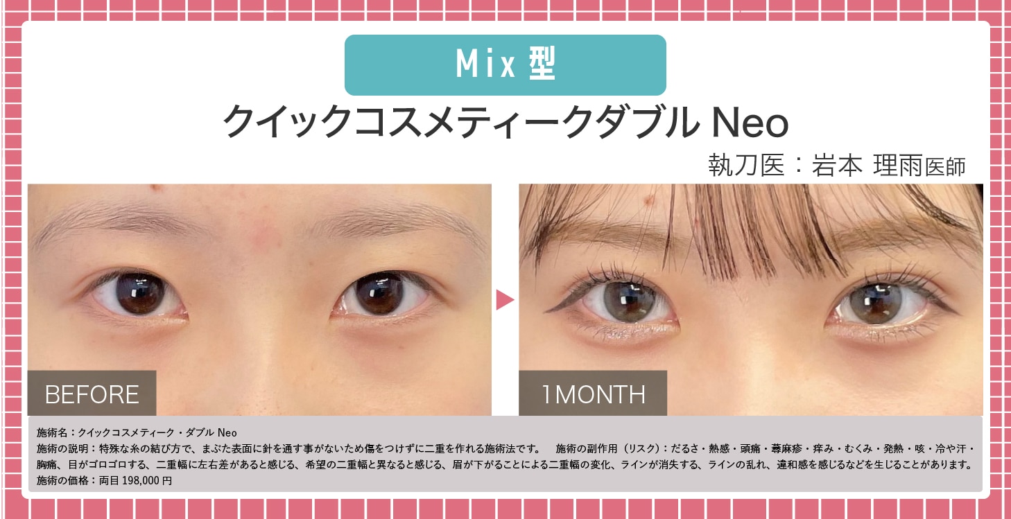 Mix型