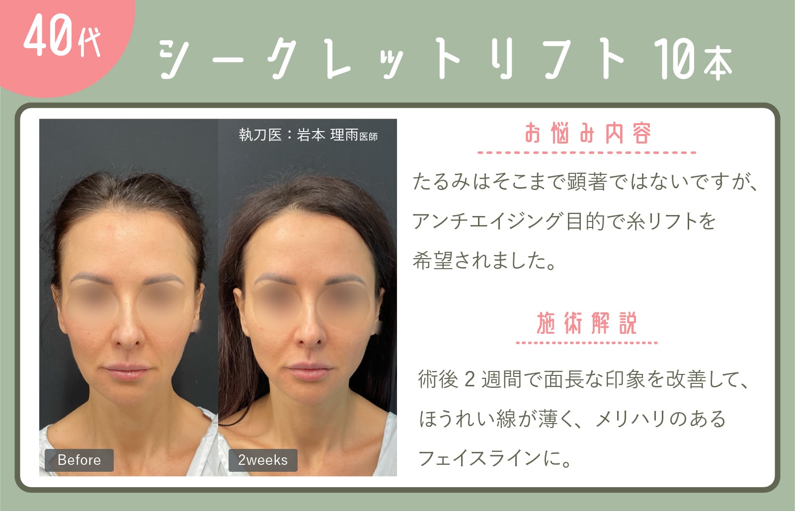 シークレットリフト