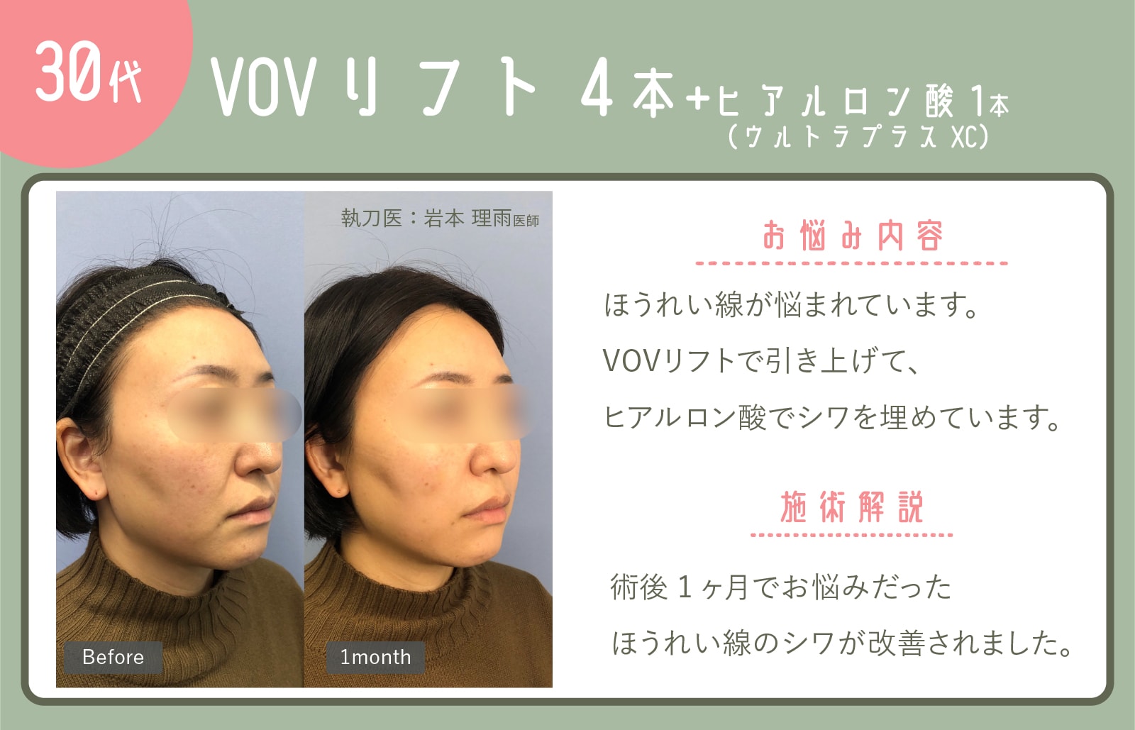 VOVリフト+ヒアルロン酸