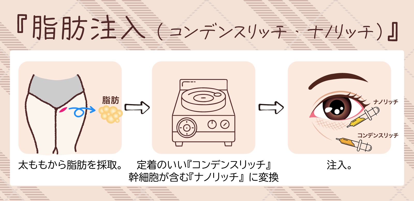 『脂肪注入』