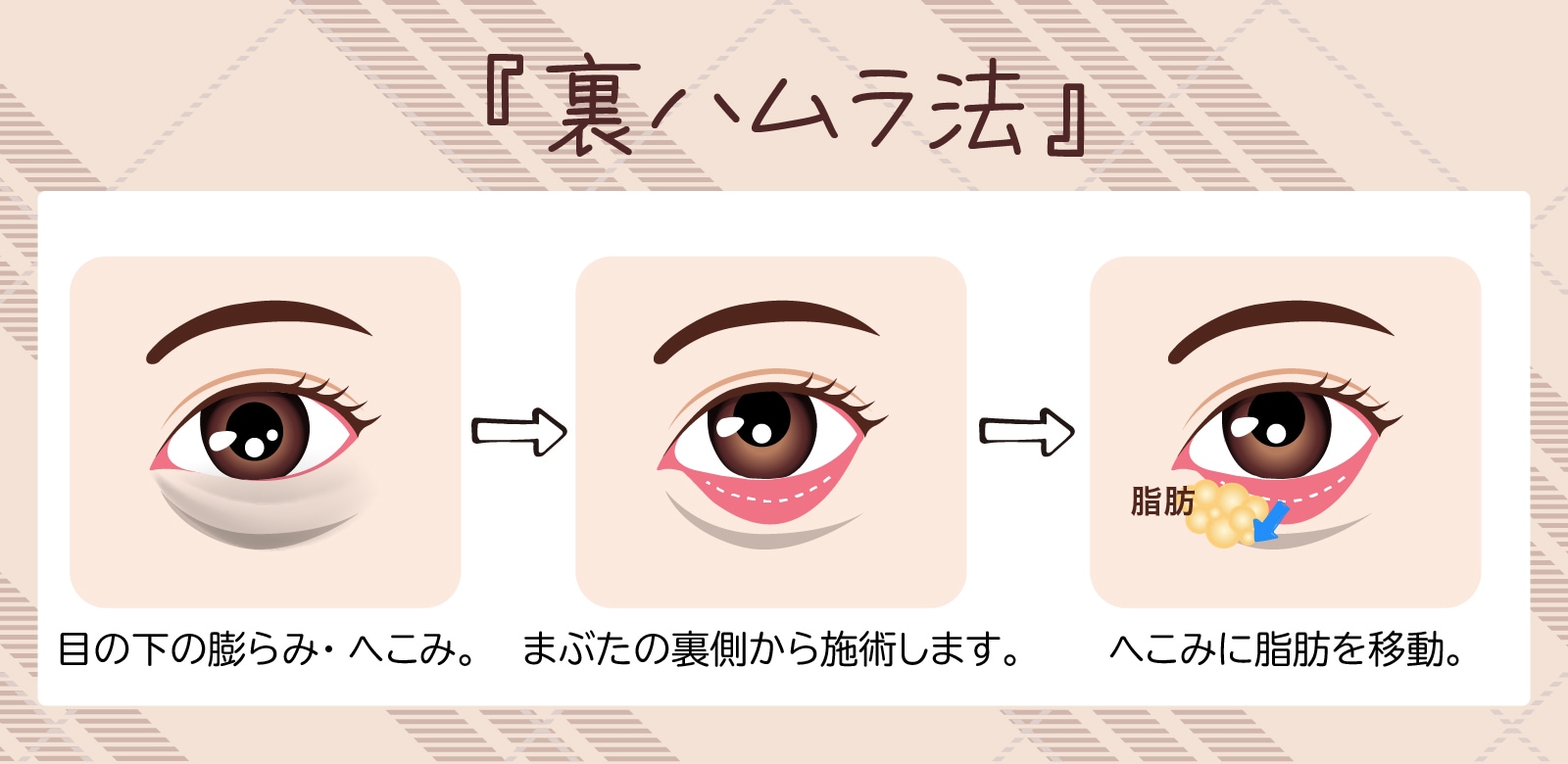 『裏ハムラ法』
