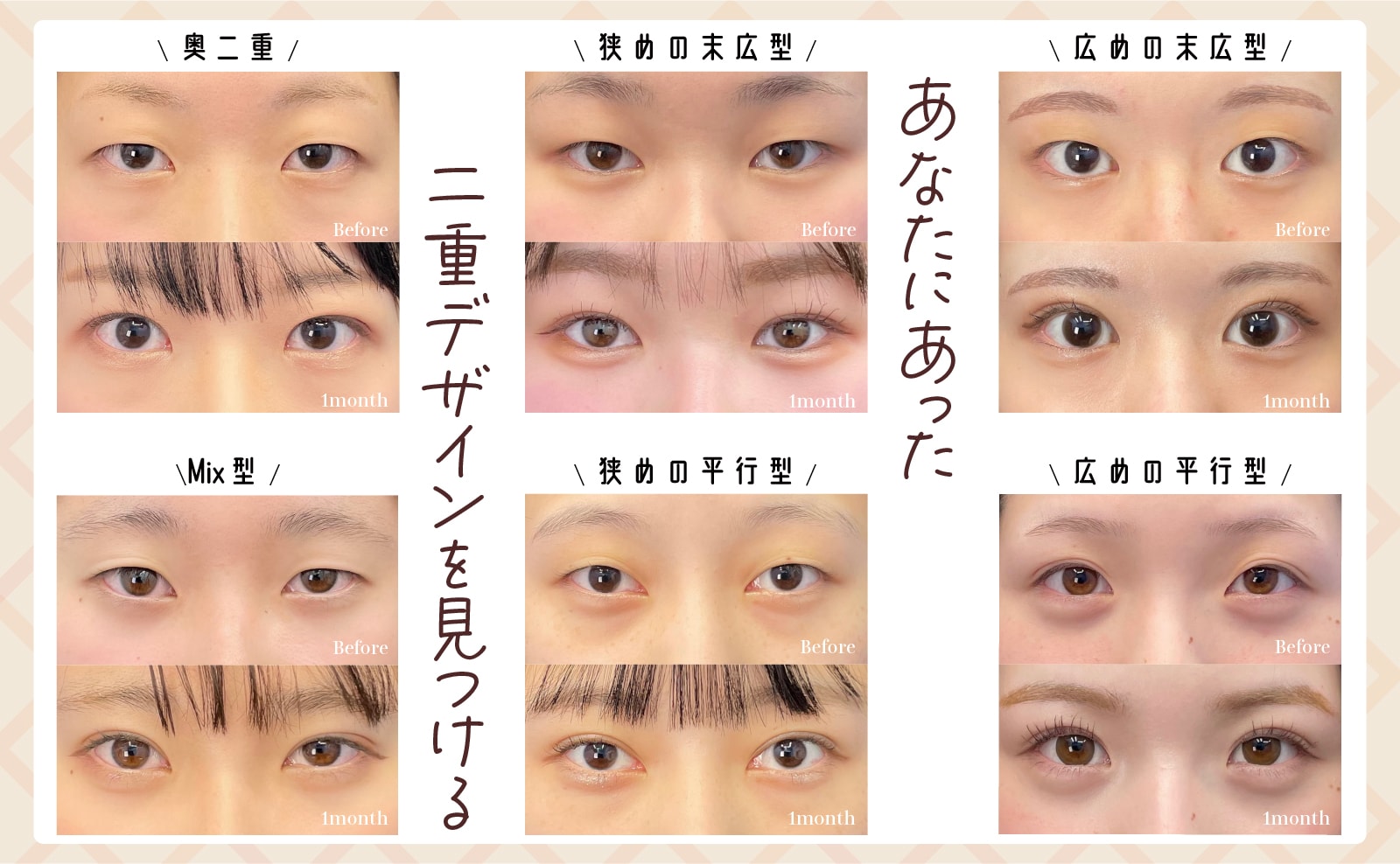糸が取れてしまうのは『アレルギー』『目に合ってないデザイン』etc...