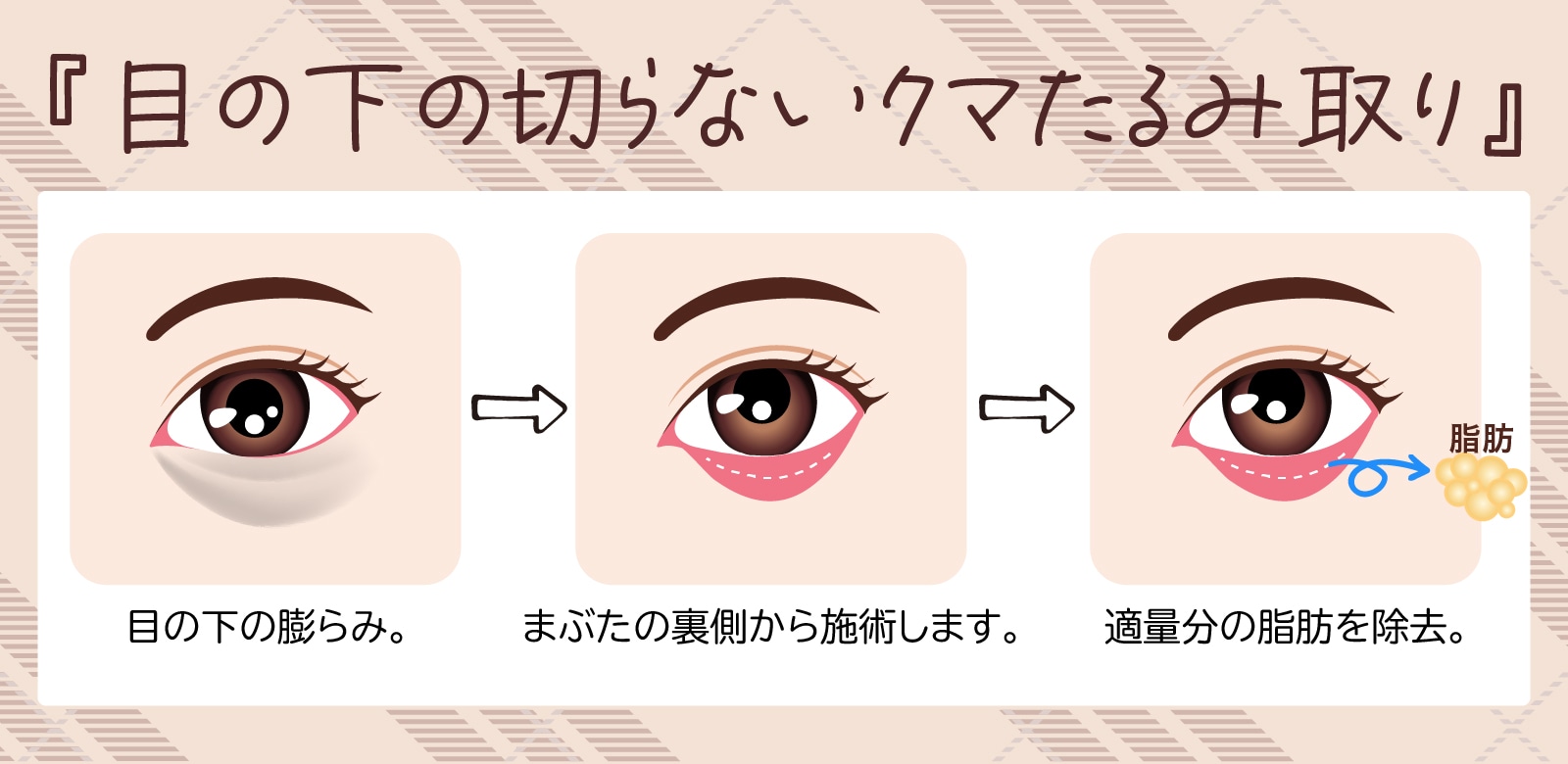 『目の下の切らないクマたるみ取り(=脱脂)』