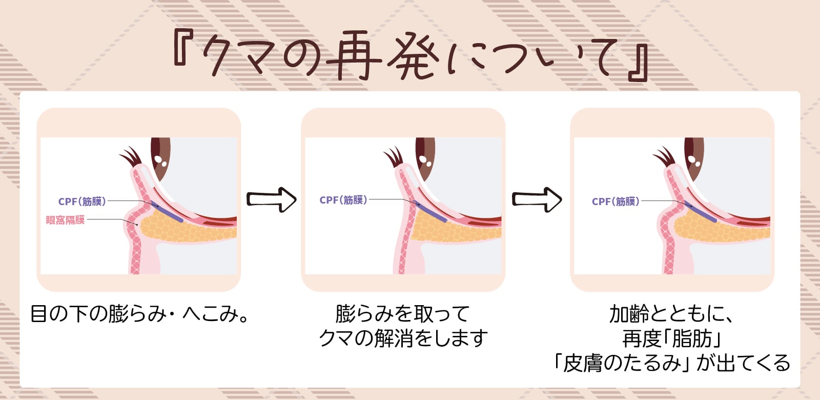 「クマ」は再発する！？