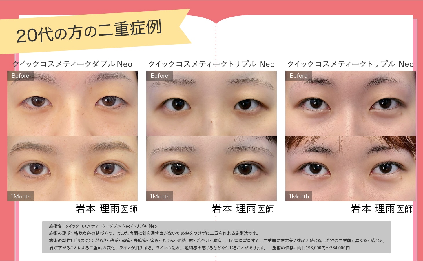 20代の方の二重症例