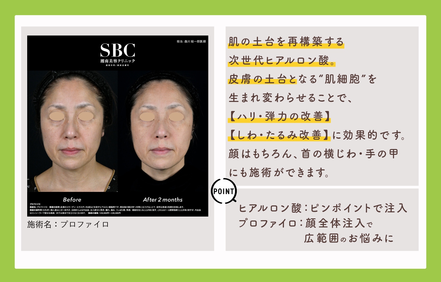 肌の土台からしわ改善_プロファイロ