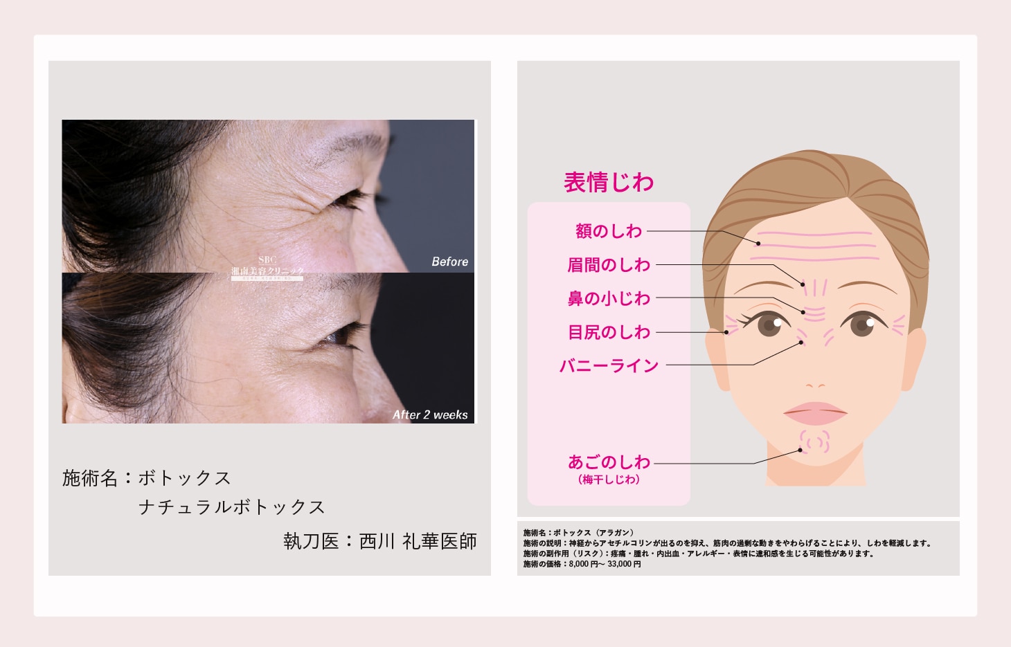 しわ取りボトックス
