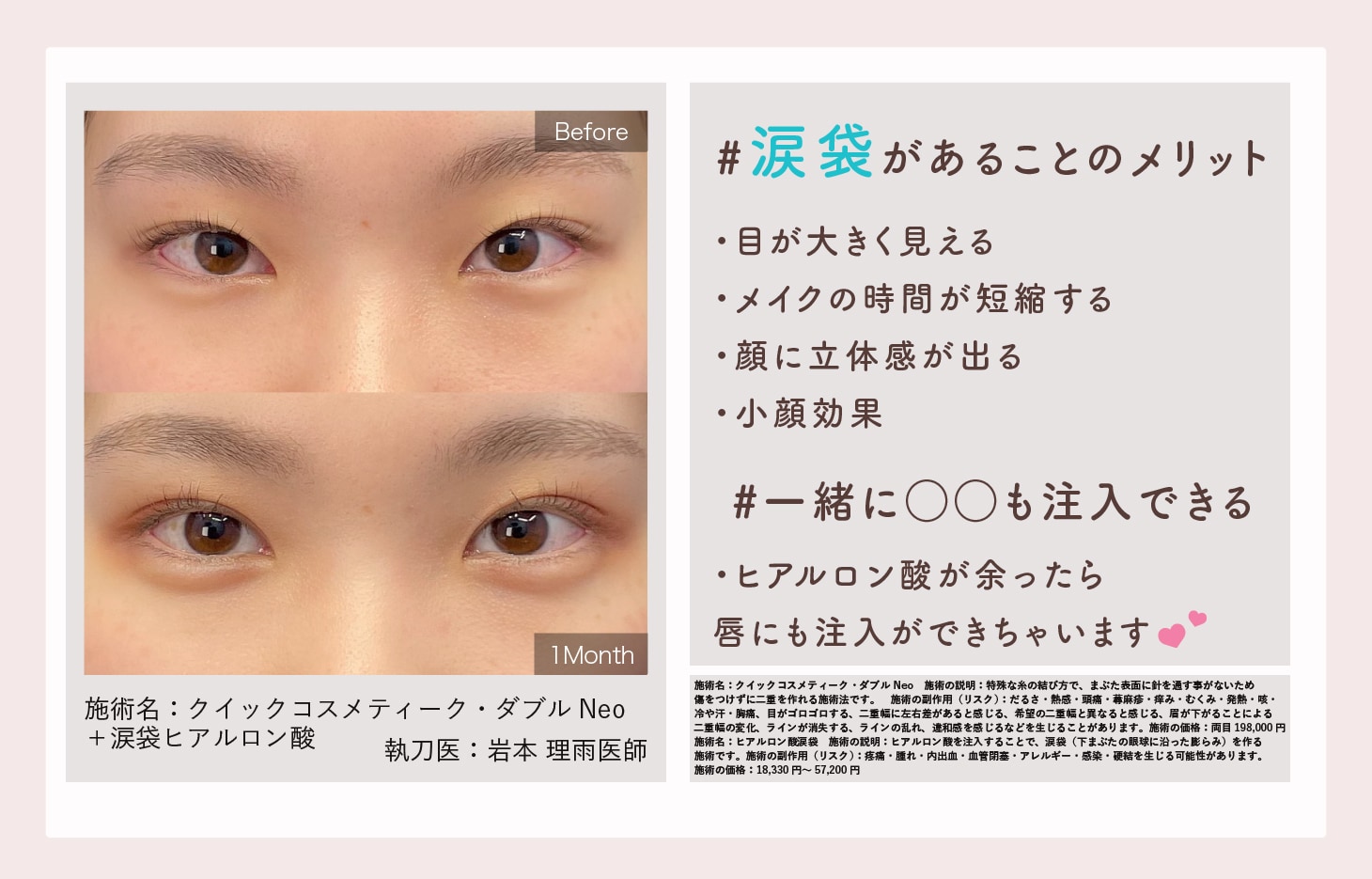 涙袋ヒアルロン酸