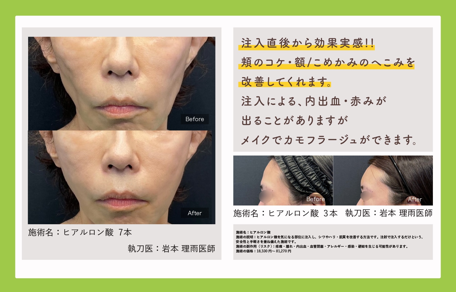 しわ改善_ヒアルロン酸