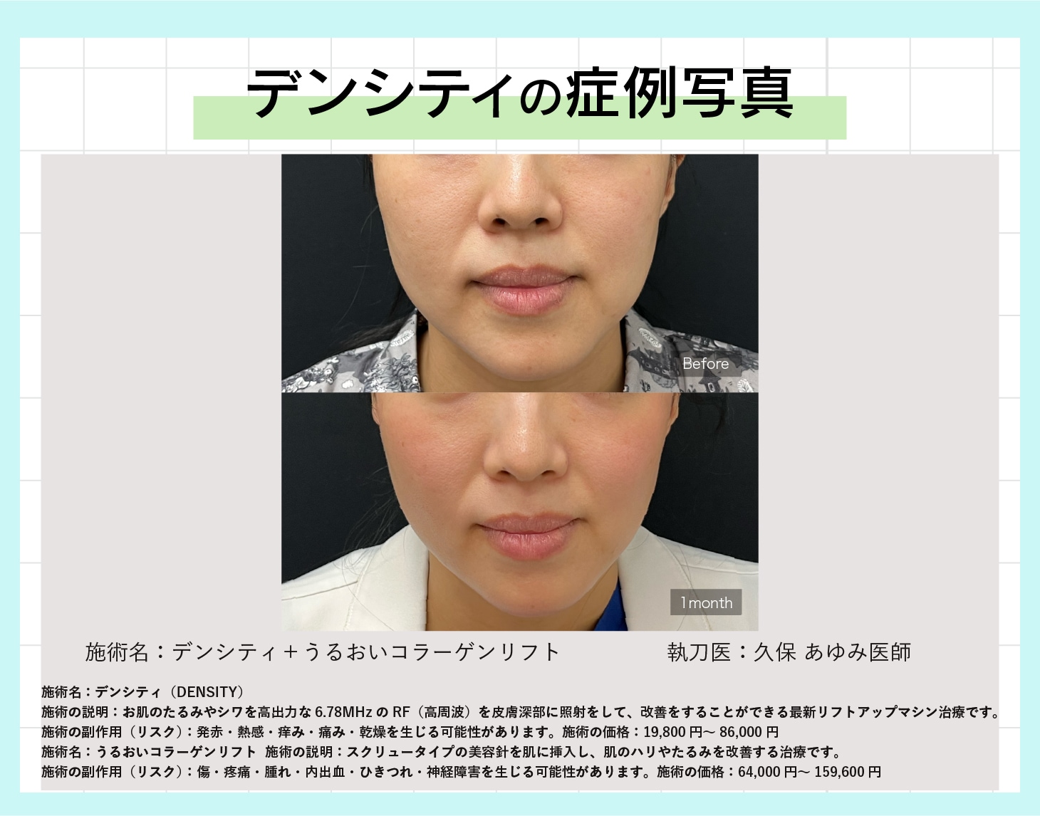 デンシティの症例