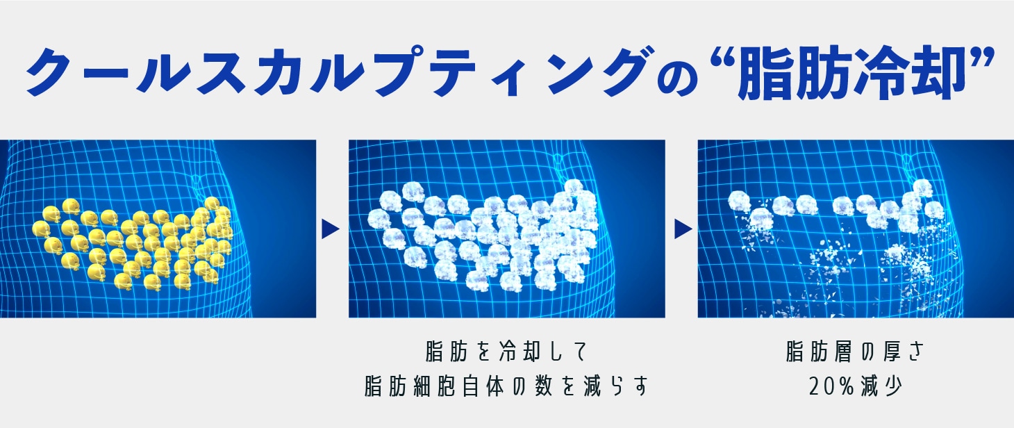 “脂肪を冷却して脂肪細胞自体を破壊・排出” 