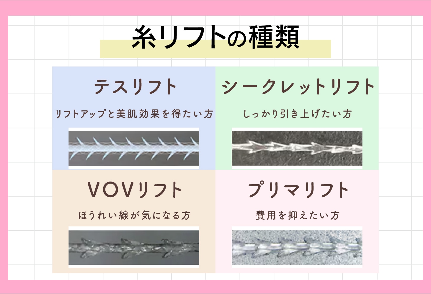糸リフトの種類