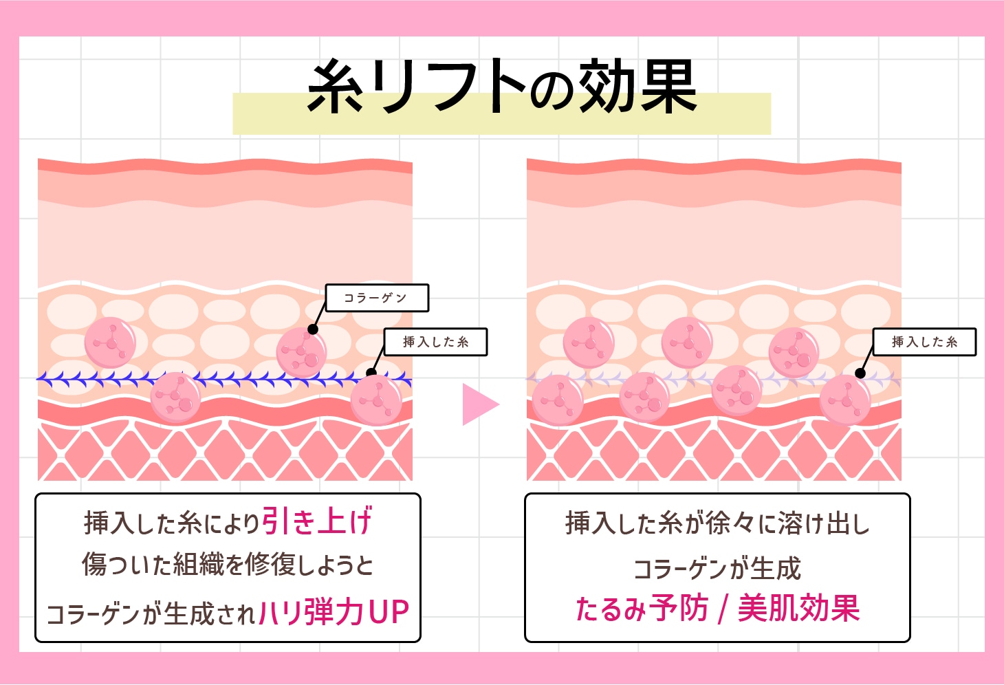 糸リフトの効果