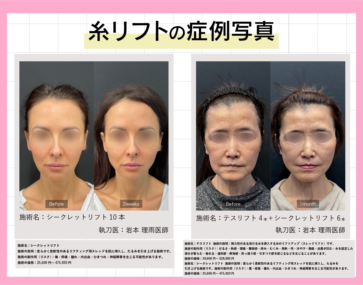 糸リフトの症例
