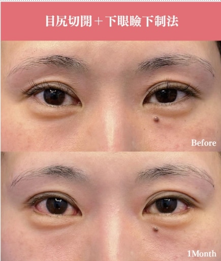 目尻切開/下眼瞼下制 