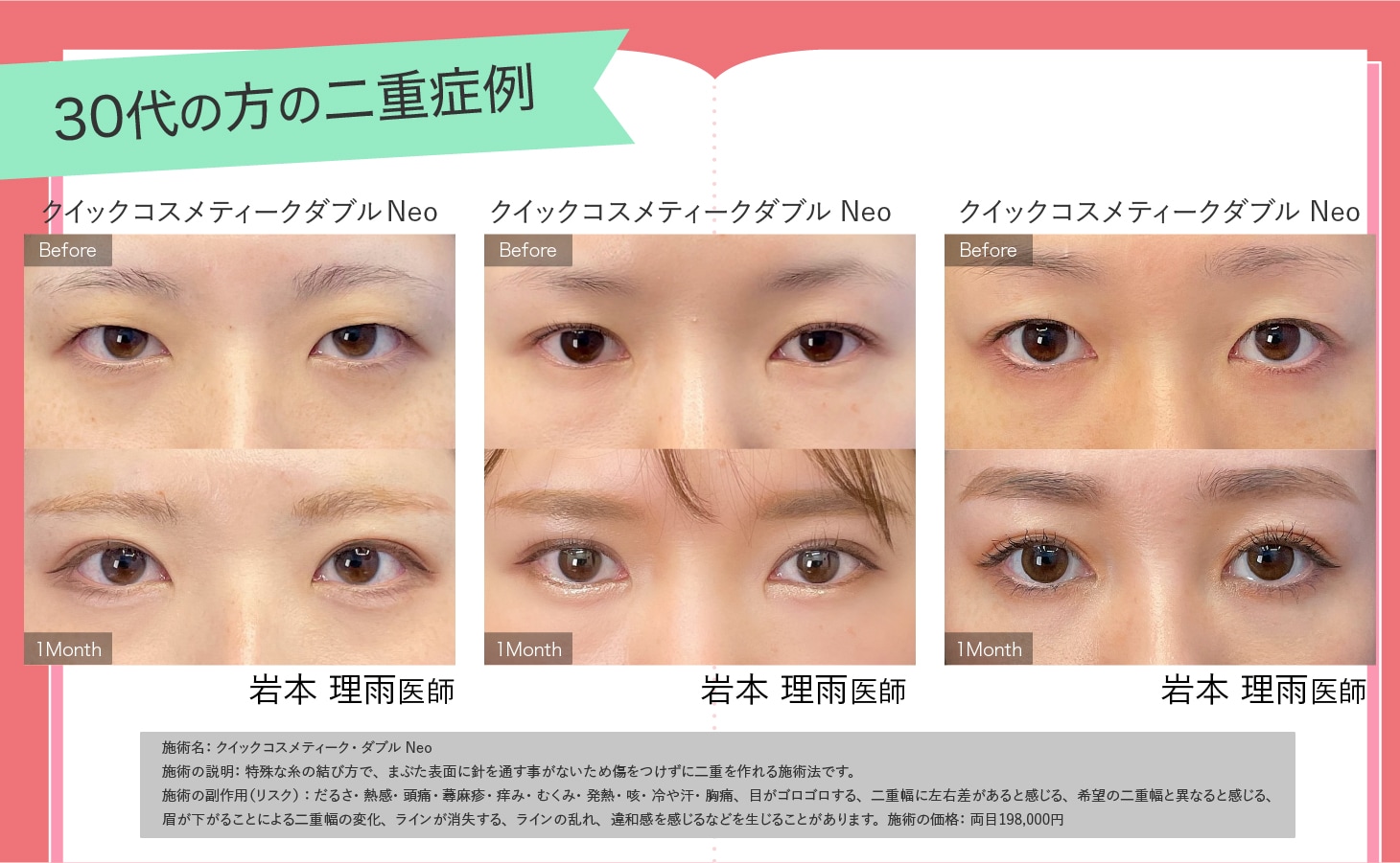 30代の方の二重症例