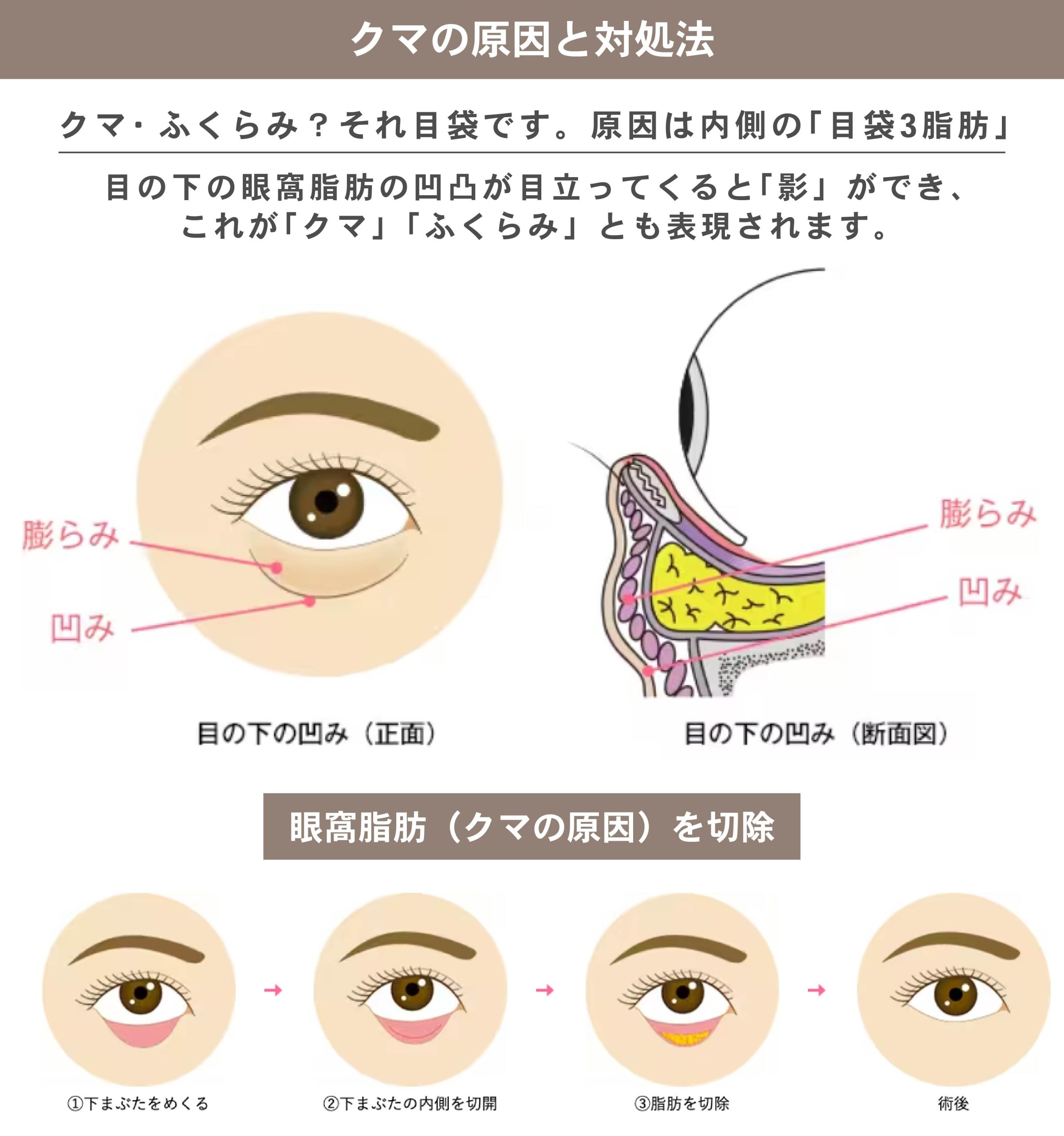 クマ・ふくらみ？それ目袋です。原因は内側の「目袋3脂肪」