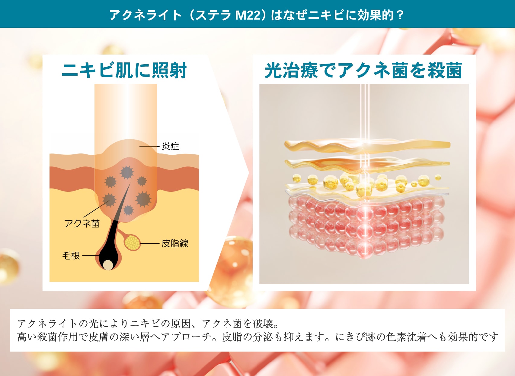 アクネライト（ステラM22）の光エネルギーでニキビの原因を照射！健康な肌に戻します