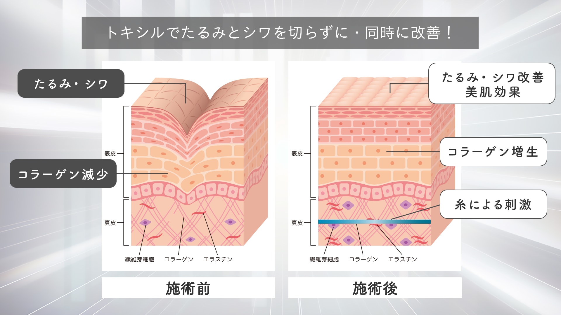 タイトニング（肌の引き締め）、しわ改善、ハリ・弾力UP