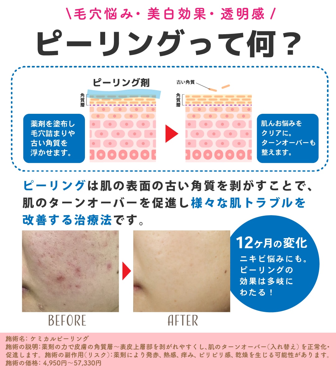お肌の表面に薬剤を塗って不要な古い角質を除去！<br />
