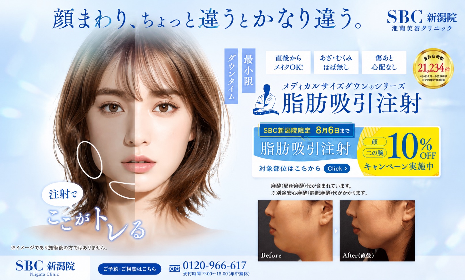 【人気NO.2】糸リフト×小顔用脂肪吸引注射