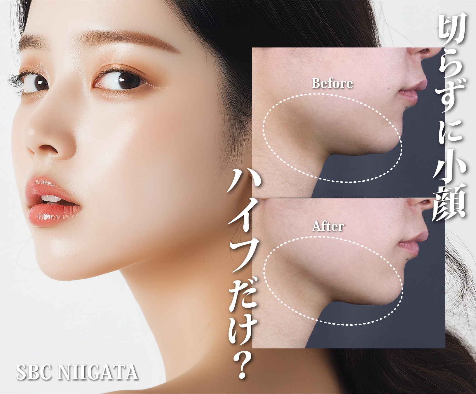 新潟で「切らないたるみ」で輪郭美人?SBCハイフで若々しいフェイス 