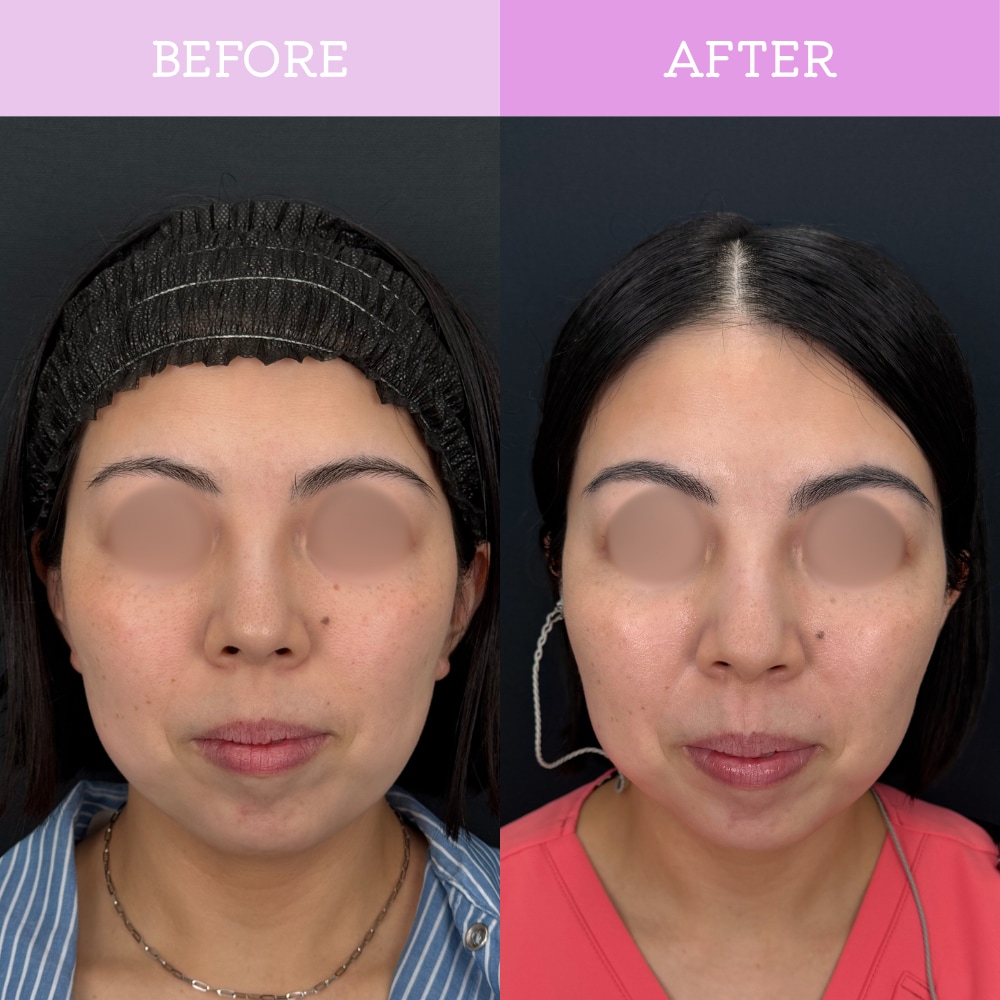 Before→After（1週間）