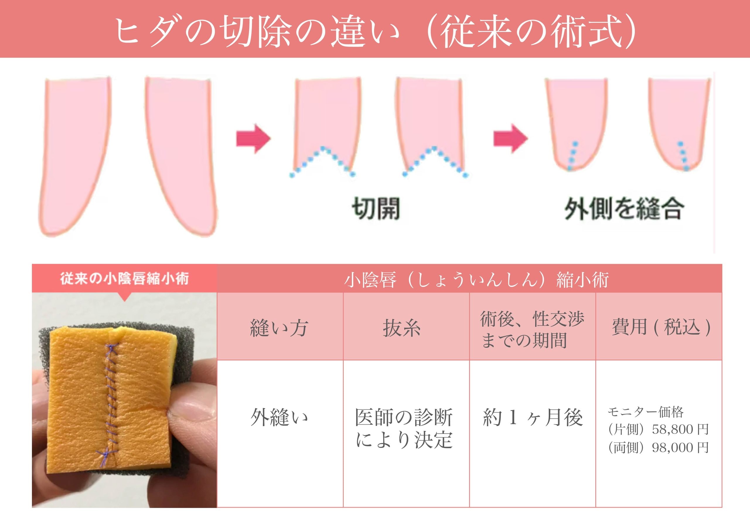 従来の小陰唇縮小術と比べて、ダウンタイムが格段に短い画期的な手術法です。