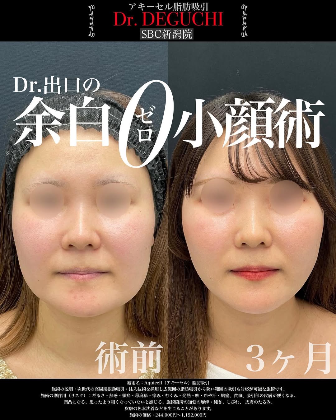糸リフトとVASER脂肪吸引(ホホジョール顎下)を受けられた方のビフォーアフターです!