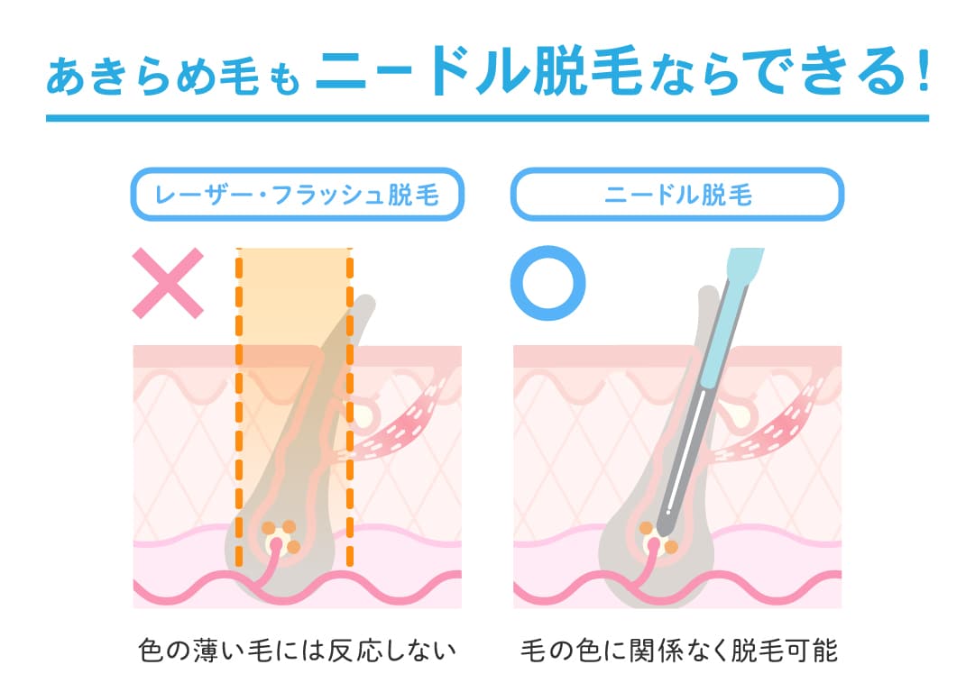 あきらめ毛もニードル脱毛なら可能！