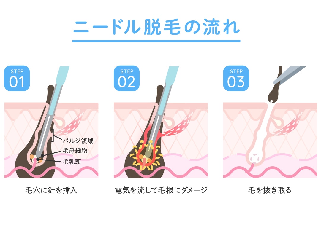 ニードル脱毛は3つのステップで施術を行います。