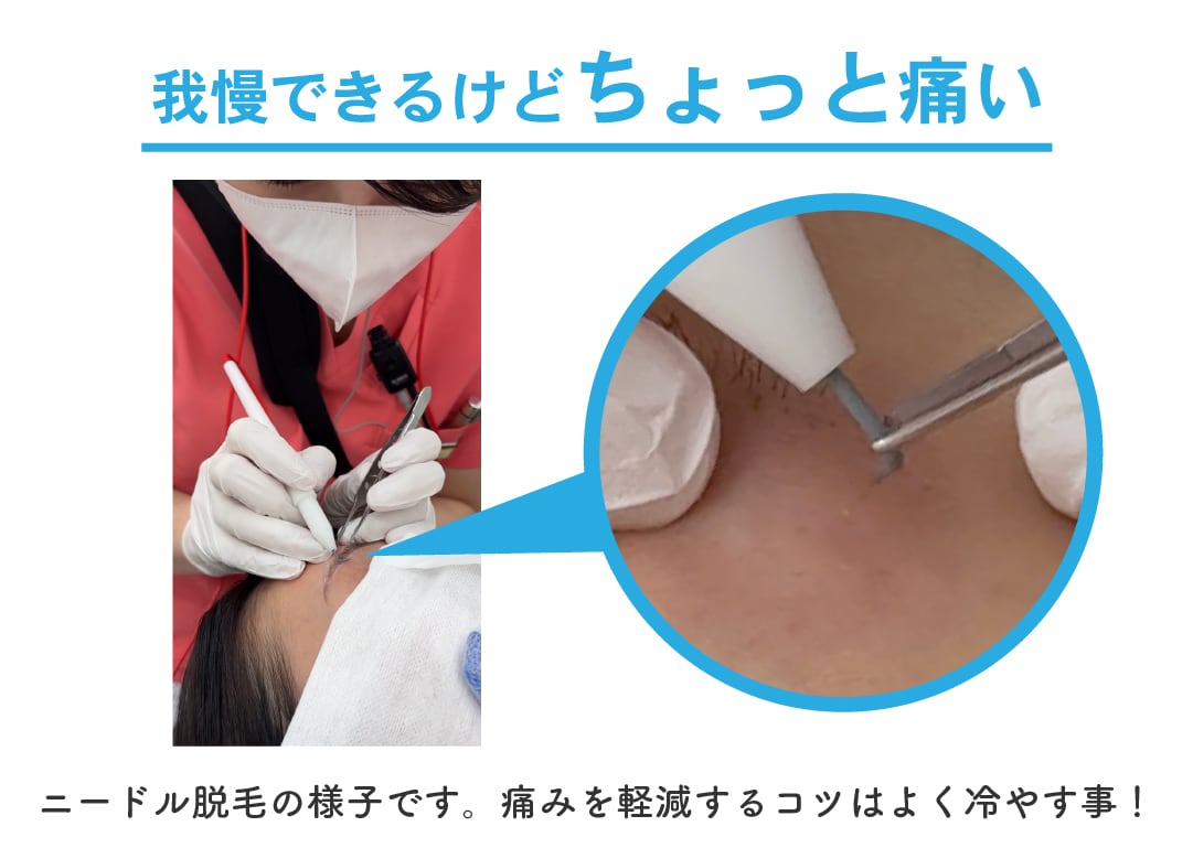 ニードル脱毛は「我慢できるけどちょっと痛い」と感じる方が多いです。 