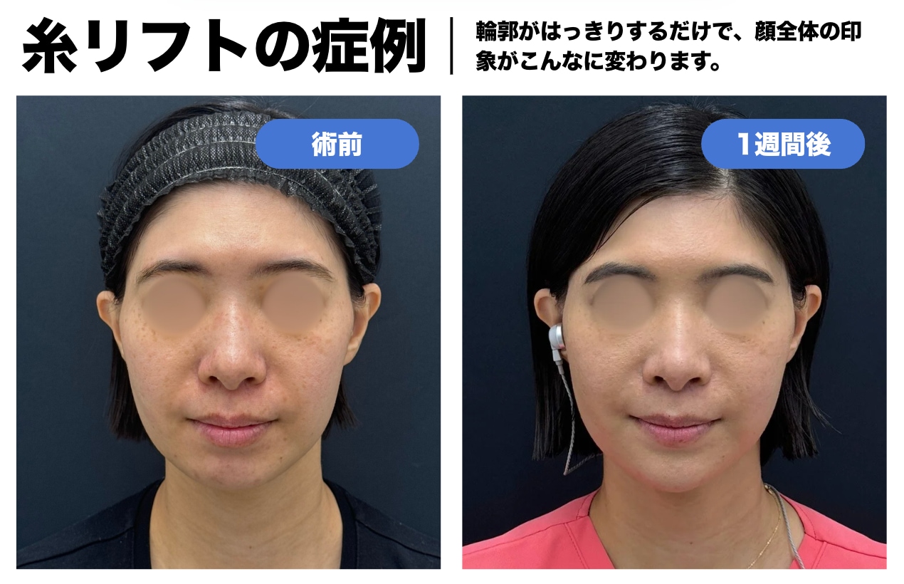 糸リフトと顎のヒアルロン酸を受けられた方のビフォーアフターです!