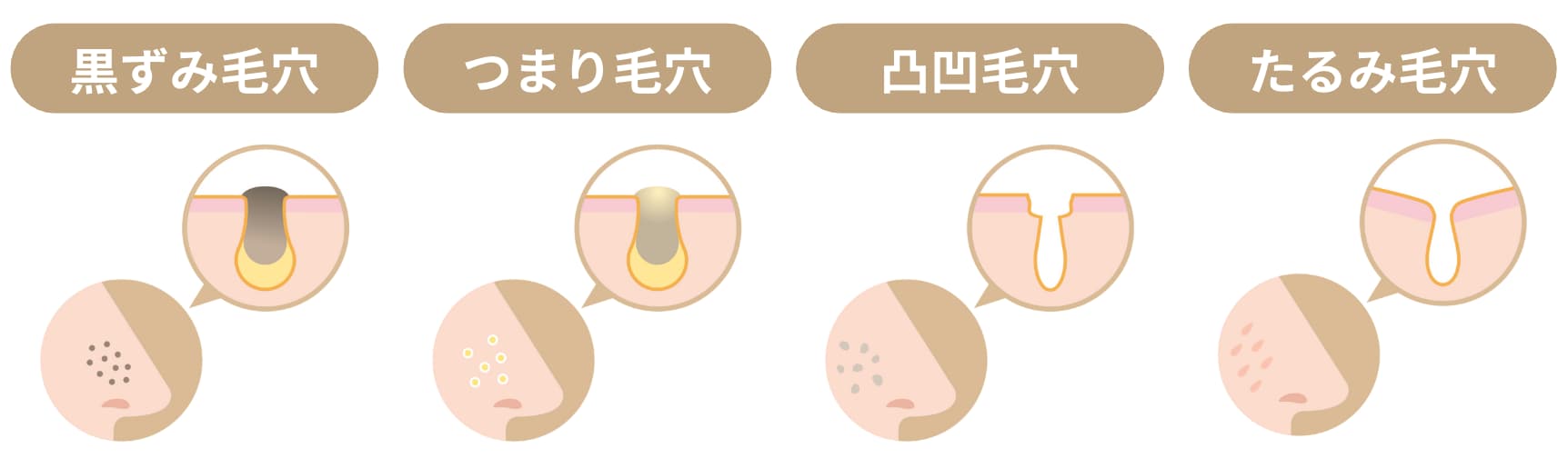 毛穴にも種類があります。あなたはどのタイプ?