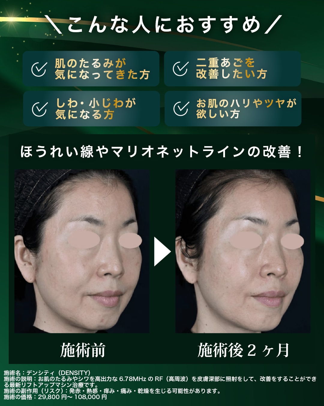 高周波エネルギーを利用して真皮層や脂肪層にアプローチする最新のたるみ治療！