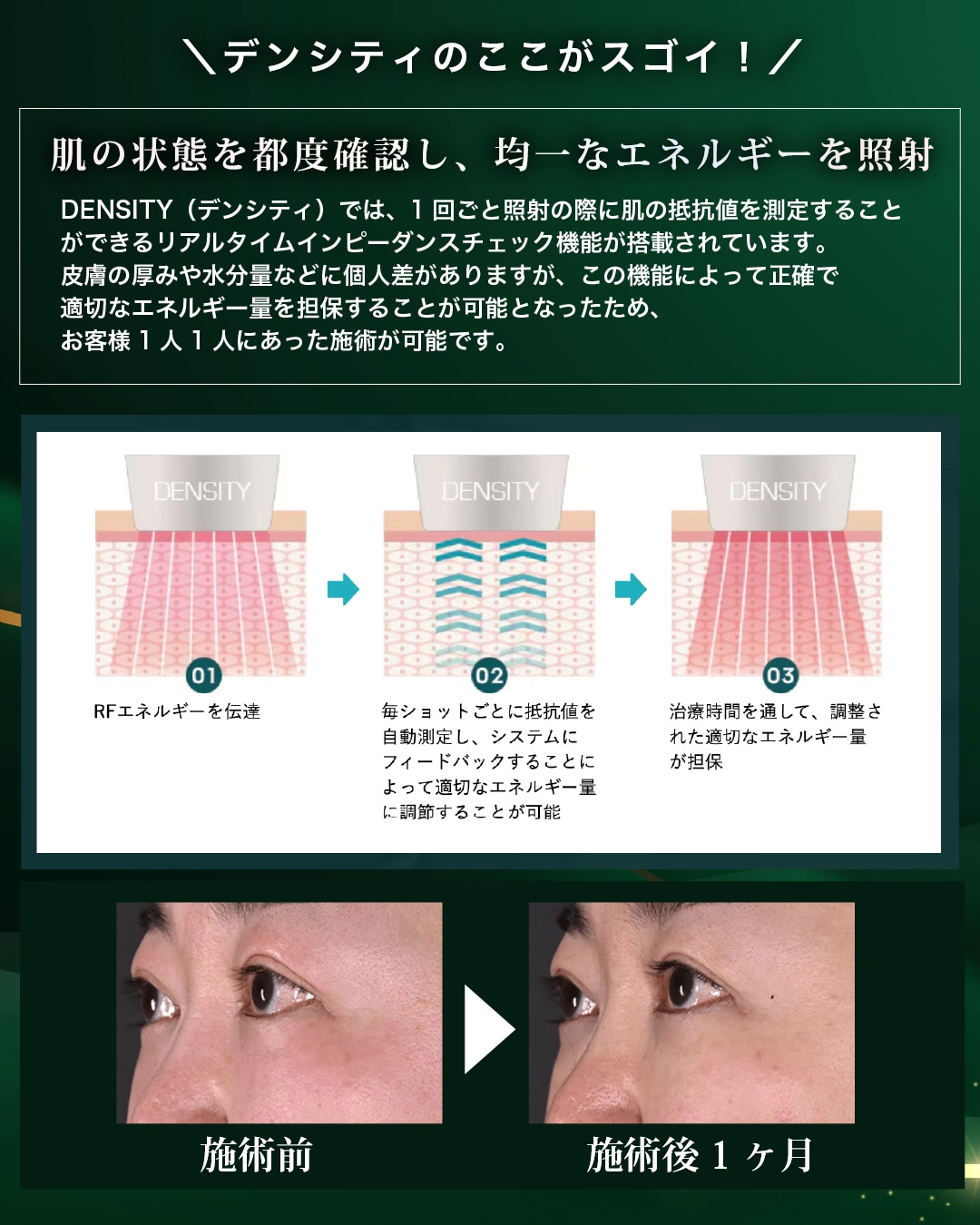 1回ごと照射の際に肌の抵抗値が測定される機能を搭載！