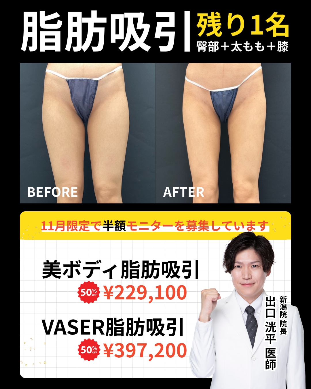 出口院長執刀。脂肪吸引が１名限定で半額