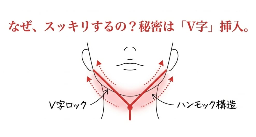 なぜ従来の糸リフトよりも効果が出やすいのか？