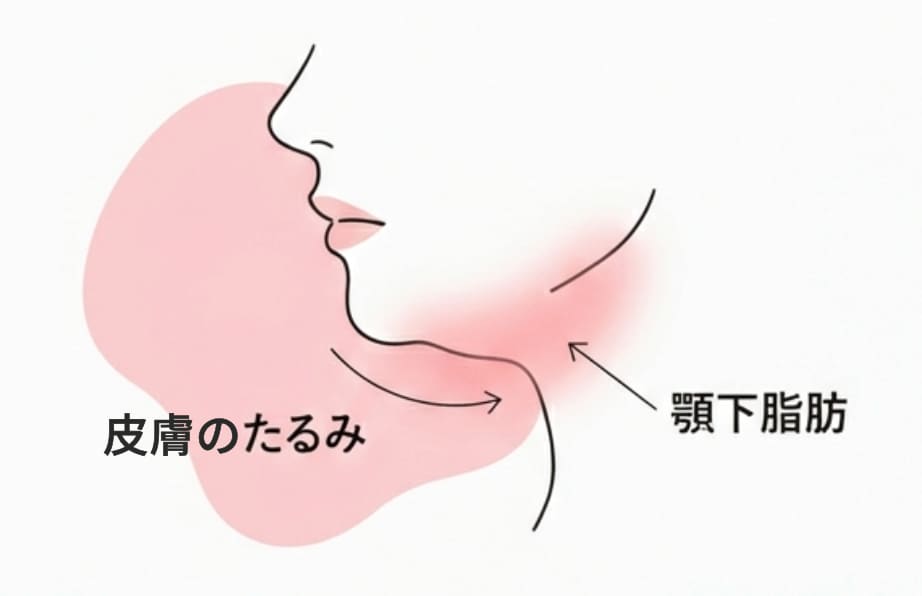 原因は脂肪だけじゃない。