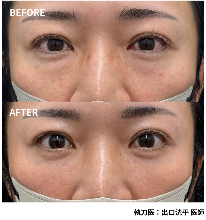 2. 段差を整える「裏ハムラ法」