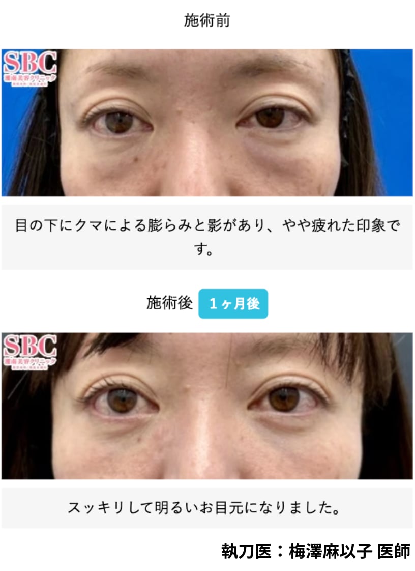 1. 手軽にスッキリ「切らないクマ取り」