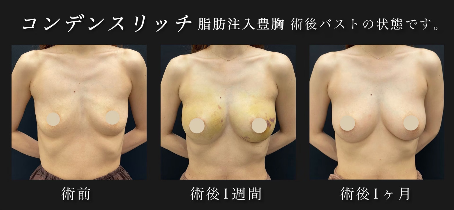 術前・術後のダウンタイム・一週間