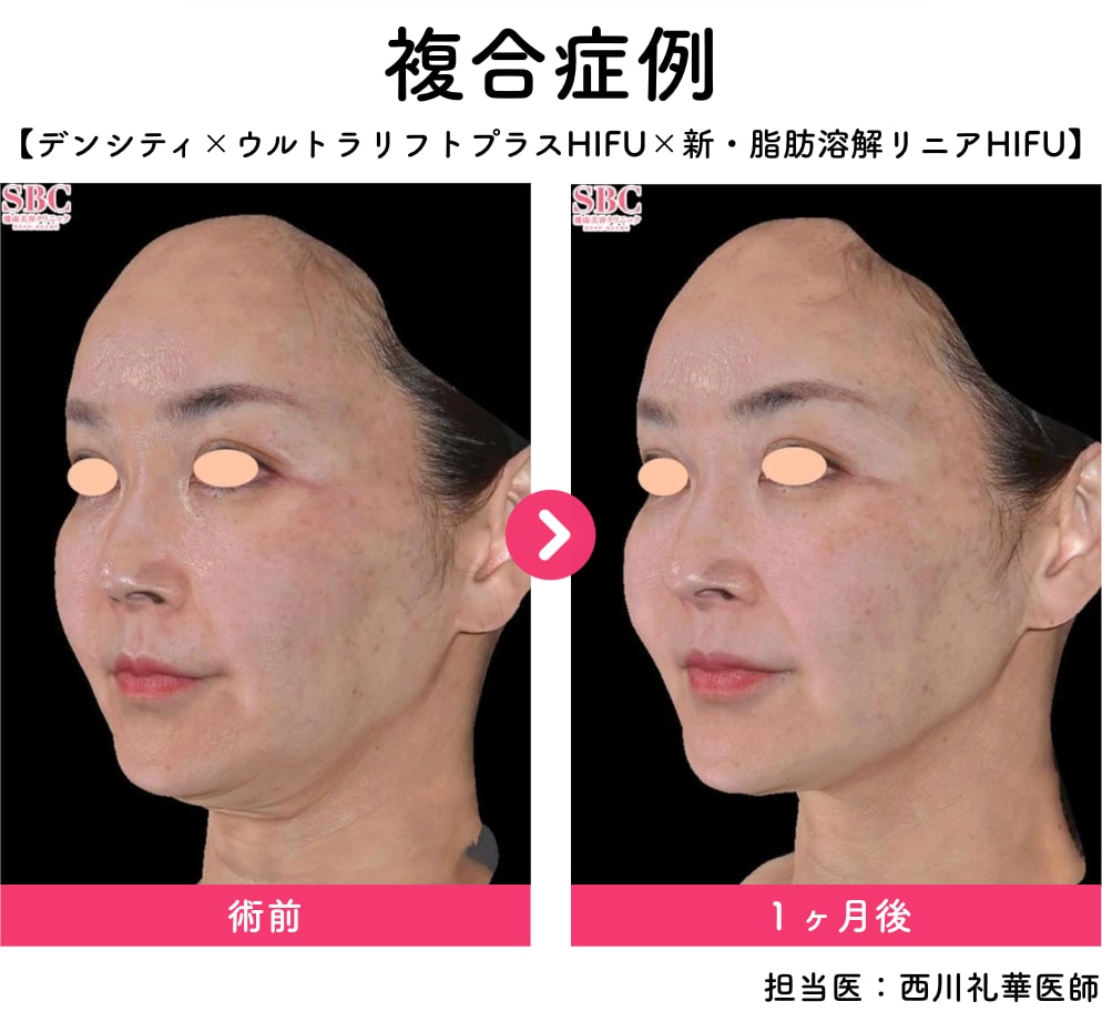 どちらも「切らないたるみ改善」を目的とした施術です