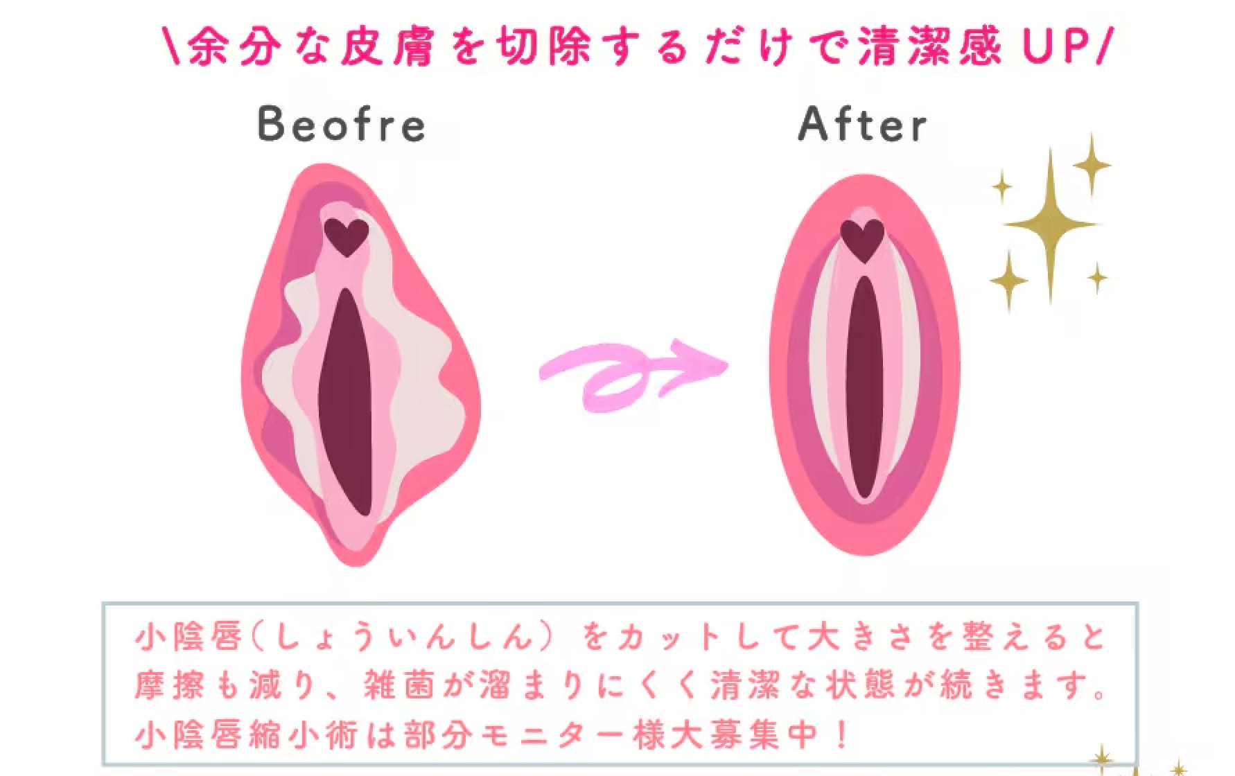 余剰の皮膚がなくなると清潔感もUP！